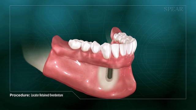 Talking With Dentures Webster Springs WV 26288